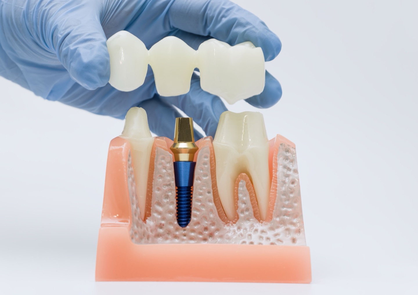A three-unit dental bridge held above a model of an implant