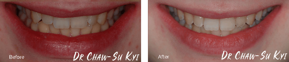 Invisalign before and after, teen patient
