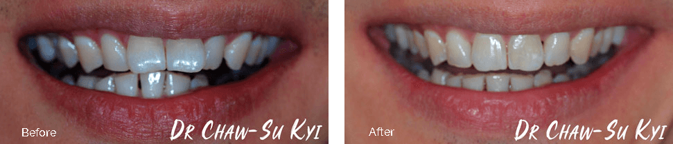 Invisalign before and after