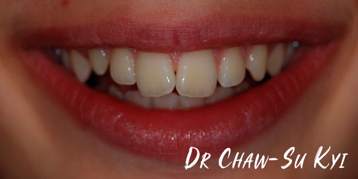 CHILDREN'S BRACES - Before Treatment  Photo, teeth, patient 4