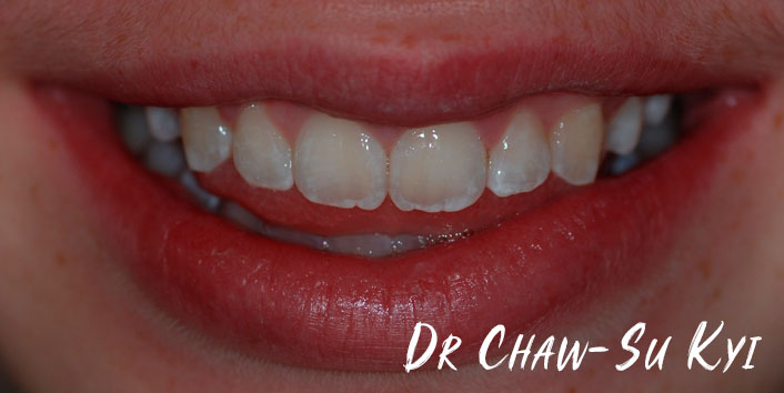 CHILDREN'S BRACES - After Treatment Photo, teeth, patient 6