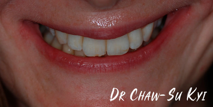 Lingual braces - After Treatment Photo, teeth, patient 1
