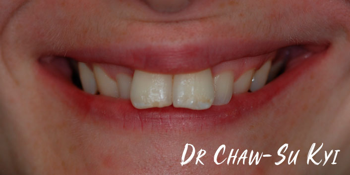 Lingual braces - Before Treatment Photo, teeth, patient 1