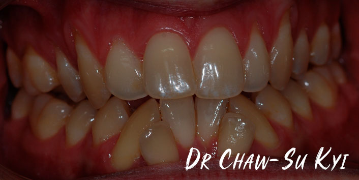 Lingual braces - Before Treatment Photo, teeth, patient 2