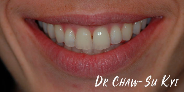 Lingual braces - After Treatment  Photo, teeth, patient 3