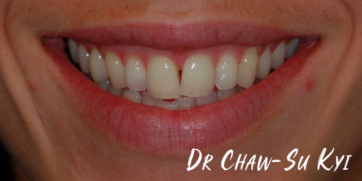 Lingual braces - After Treatment  Photo, teeth, patient 3