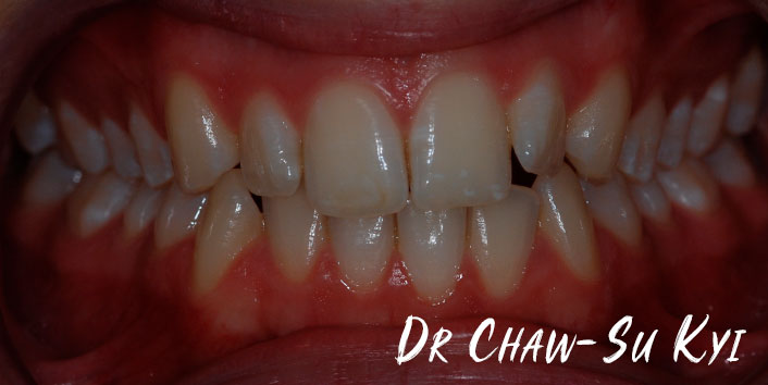 Lingual braces - Before Treatment Photo, teeth, patient 4