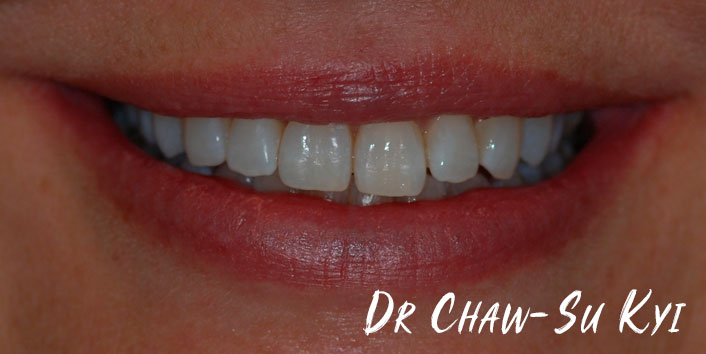 Lingual braces - After Treatment Photo, teeth, patient 5