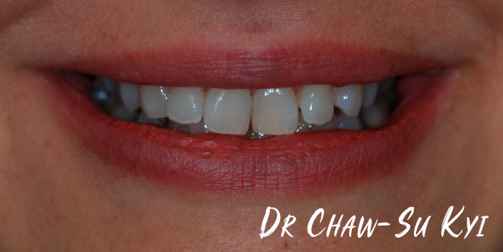 Lingual braces - Before Treatment Photo, teeth, patient 5