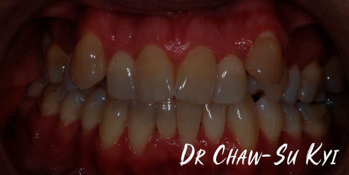 Lingual braces - Before Treatment Photo, teeth, patient 6