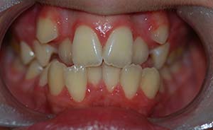Braces and Teeth Extraction: Severe crowding