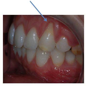 Gum recession on the canine tooth. Photo patient