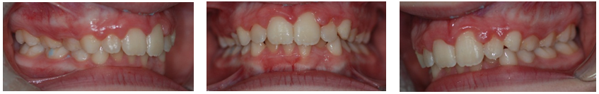 after orthodontic treatment