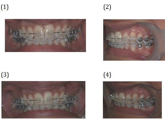 Adjusted Braces. Before and After Photos - patient (frontal view, oblique view)