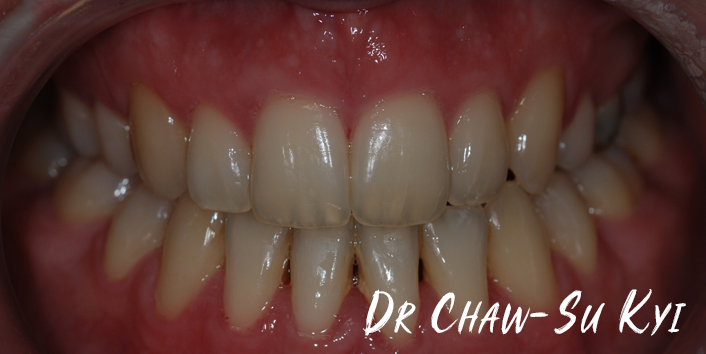 After Adult braces Treatment, teeth photo, patient 29