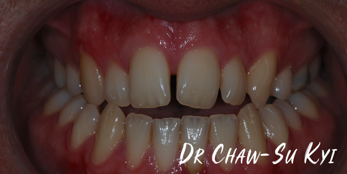 Before Adult braces Treatment, teeth photo, patient 29