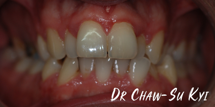 Before Adult braces Treatment, teeth photo, patient 39