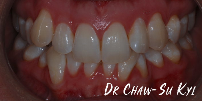 Before Adult braces Treatment, teeth photo, patient 30