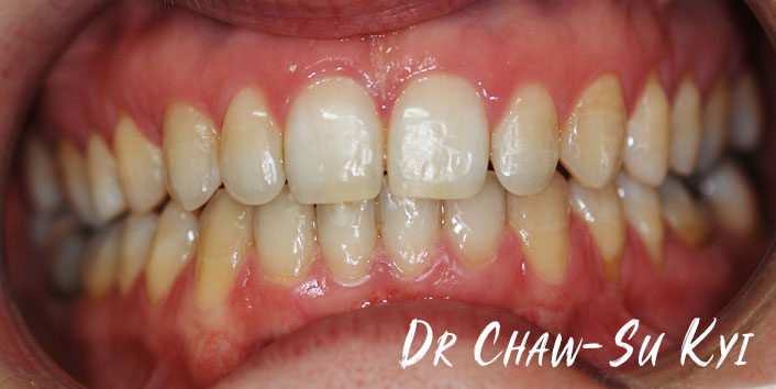 After Adult braces Treatment, teeth photo, patient 37